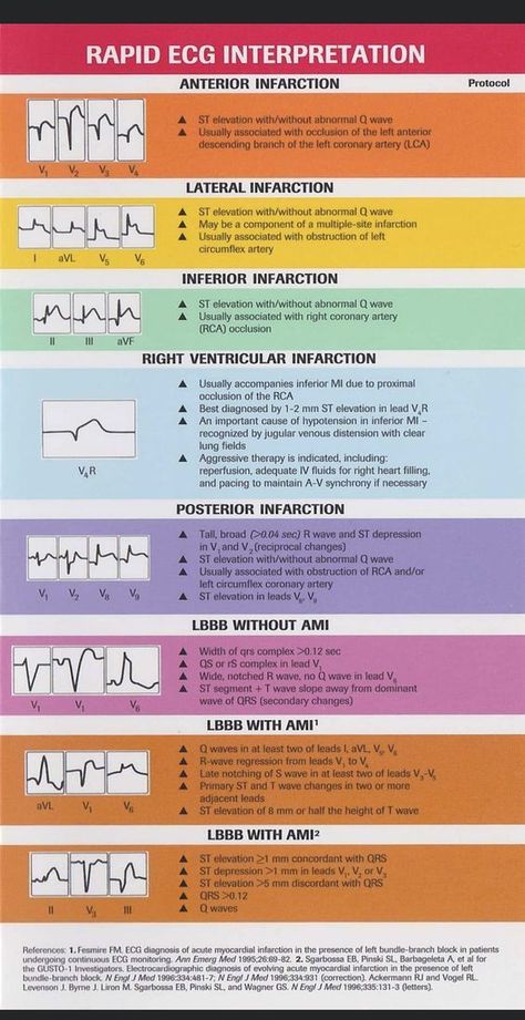 Rapid ECG interpretation #medicalschool #resources #medicalstudent - Image Credits: Ashley DeTuncq Mrcp Part 1 Notes, Stemi Ekg, Ecg Interpretation, Medical Assistant Student, Sistem Saraf, Paramedic School, Nursing School Essential, Nurse Study Notes, Nursing Mnemonics