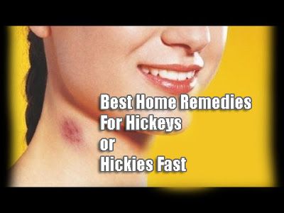 Ways to Get Rid of Hickeys or Hickies Fast (Home Remedies), Best Home Remedies For Hickeys or Hickies Fast, home remedies, How to  to Get Rid of Hickeys Fast, Get Rid Of Hickies, Importance Of Mental Health, Under The Skin, Keeping Healthy, Natural Home Remedies, Blood Vessels, Facial Skin Care, Game Night, Body Health