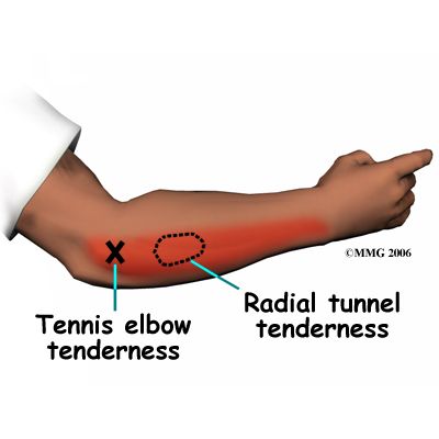 Lateral Epicondylitis (Tennis Elbow) | eorthopod. Radial Tunnel Syndrome, Tennis Elbow Relief, Tennis Elbow Symptoms, Tennis Elbow Exercises, Elbow Exercises, Elbow Pain Relief, Radial Nerve, Elbow Brace, Therapy Exercises