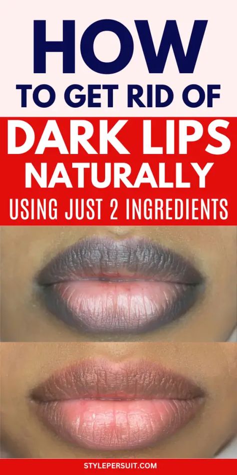 DARK LIPS  REMEDIES Remedies For Dark Lips, For Dark Lips, Home Remedies For Warts, Lip Lightening, Warts Remedy, Natural Remedies For Migraines, Sunburn Relief, Dark Underarms, Dry Skin Remedies