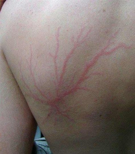 Classic Web-Like Pattern From is listed (or ranked) 7 on the list These Photos Show What Happens After You Get Struck By Lightning Struck By Lightning Scar, Lightning Scar, Lightning Photos, Lichtenberg Figures, Struck By Lightning, Lightning Strikes, Lightning Bolt, Leaf Tattoos, Triangle Tattoo