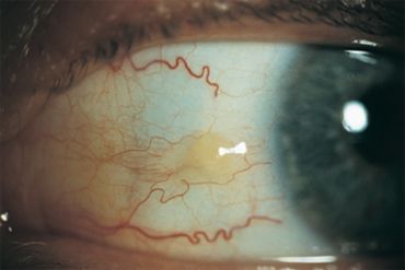 Red Veins In Eyes, Laser Vision, Eye Facts, Laser Eye Surgery, Red Veins, Laser Eye, Eye Infections, Healthy Eyes, Eye Surgery