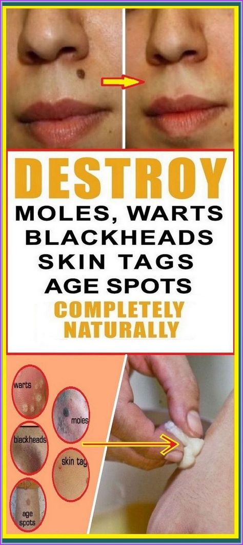 Destroy Your Moles, Warts, Blackheads, Skin Tags And Age Spots Completely Naturally Essential Oils For Fever, Constipation Relief Foods, Homemade Cold Remedies, Dark Mole, Remedies For Inflammation, Skin Pictures, Home Remedies For Cough, Skin Moles, Honey Face Mask