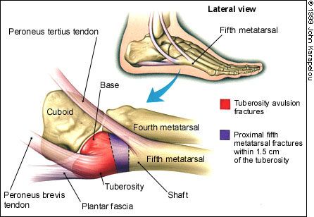 Fractures of the Proximal Fifth Metatarsal - American Family Physician Physiotherapy Knowledge, Fracture Photo, Jones Fracture, Metatarsal Fracture, Lisfranc Injury, Ankle Anatomy, Avulsion Fracture, Ankle Fracture, Body Bones