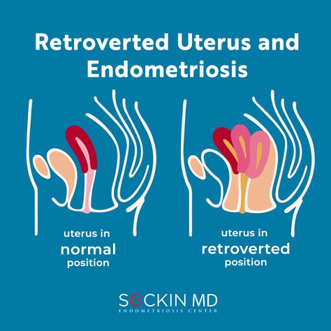 Do you have a tilted #uterus? How has this affected your life? Please share your story by leaving a comment. #endometriosis Read More: https://drseckin.com/retroverted-uterus-and-endometriosis/ Tilted Uterus, Retroverted Uterus, Healthy Life Inspiration, Postpartum Health, Female Health, Quick Workouts, Hair Care Growth, Maternal Health, Child Psychology