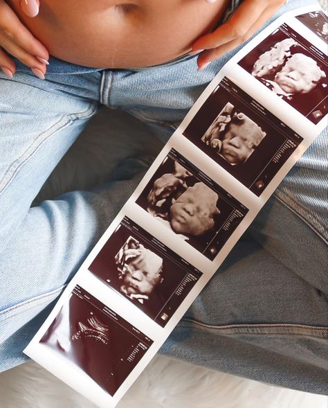 #5Dultrasound #ultrasound #pregnancy #30weekspregnant #babygirl 3d/4d Ultrasound Studio Decor, 20 Week Ultrasound Pictures, 5 Week Ultrasound Pictures, 30 Week Ultrasound, 15 Week Ultrasound, 4d Ultrasound Pictures, Ultrasound Room, 4d Ultrasound, Benjamin Wadsworth