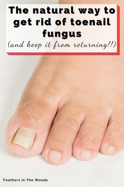 The absolute best natural remedy for toenail fungus. Don't use harsh chemicals on your delicate nails! Treat your nail fungus naturally and get rid of it for good. Simple steps using a common essential oil to get rid of foot fungus and keep it from coming back. Nail Remedies, Fingernail Fungus, Toenail Fungus Remedies, Nail Infection, Nail Fungus Remedy, Fungal Nail, Ingrown Toe Nail, Toenail Fungus, Nail Fungus