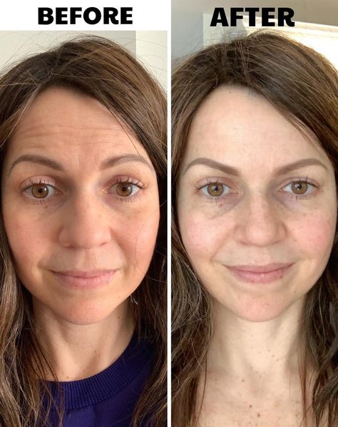 Botox Before And After, Eyebrow Lift, Anti Wrinkle Injections, Botox Injections, Style Makeover, Anti Aging Facial, Hair Removal Cream, Healthy Sides, Anti Aging Treatments