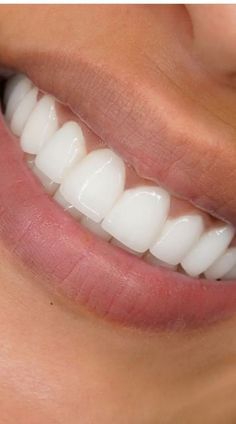 Desired Teeth, Perfect Teeth Smile, Physical Vision Board, Nfl Titans, Hairstyles For Fall, Pretty Teeth, Getting Braces, Braces Off, Crest 3d White