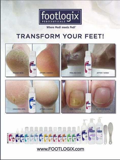 Nail Infection Footlogix Products, After Poster, Sunburn Peeling, Natural Face Care, Salon Quotes, Hand And Foot Care, Nail Infection, Spa Business, Diy Body Scrub