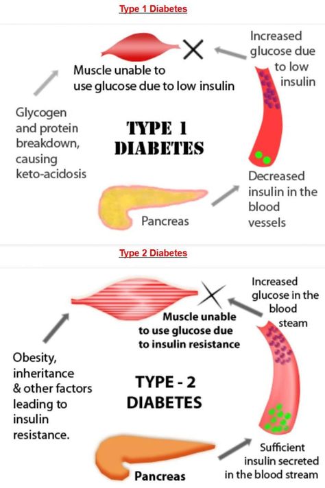 Medical Mnemonics, Nursing Tips, Nursing Notes, Medical Knowledge, Double Tap, Type 1, Tap, Human Body, Medical