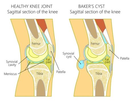 Fluid On The Knee, Meniscus Injury, Knee Meniscus, Meniscal Tear, Swollen Knee, Anterior Cruciate Ligament, Weight Bearing Exercises, Synovial Fluid, Musculoskeletal Pain