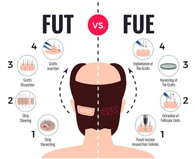 Is fut or fue hair transplant? Hair Transplant Results, Hair Transplant Procedure, Skin And Hair Clinic, Fue Hair Transplant, Hair Transplant Surgery, Best Hair Transplant, Hair Clinic, Hair Specialist, Skin Disorders