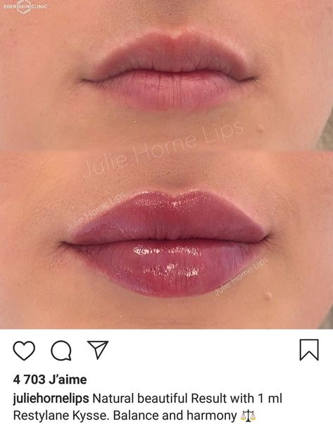 Lip Filler Shape Ideas, Lip Fillers Juvederm, Get Fuller Lips Naturally, Lips Fillers, Fuller Lips Naturally, Lips Shape, Lips Inspiration, Lip Types, Permanente Make-up