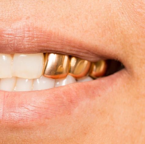 Why Permanent Gold Teeth Implants Are Good for You Gold Tooth Crown, One Gold Tooth Women, Gold Tooth Women, Gold Teeth Women, Gold Teeth Men, Permanent Gold Teeth, Gold Tooth Cap, Golden Tooth, All On 4 Dental Implants