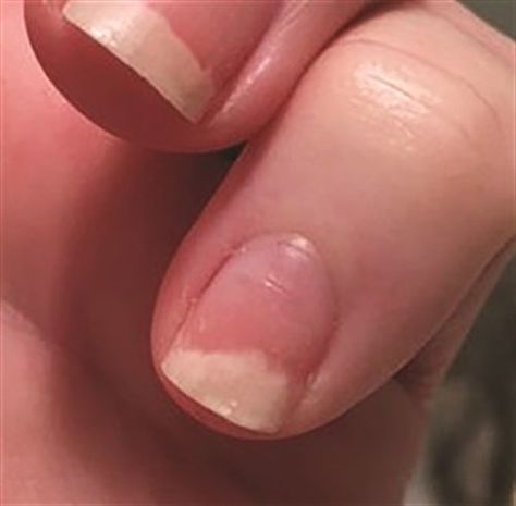 I injured my nail causing it to lift from the nail bed. Is the nail damaged for good? - Health - NAILS Magazine Nail Damage Remedies, Nail Bed Damage, Toenail Problems, Nail Disorders, Nails After Acrylics, Black Halloween Nails, Nail Problems, Nail Infection, Ingrown Toenail