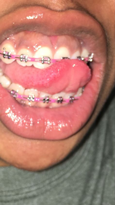 Dark Pink Braces, Pink Power Chain Braces, Chain Braces, Pretty Braces, Braces Pink, Perfect Teeth Braces, Braces Aesthetic, Power Chain Braces, Braces Colours