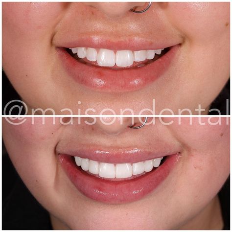 Teeth Bonding Before And After, Teeth Composite, Teeth Bonding, Composite Bonding, Crooked Teeth, Perfect Teeth, The Teeth, White Patches, Vision Board