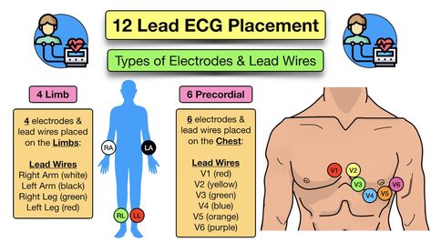 Ekg Leads Placement, Ekg Electrode Placement, Ecg Lead Placement, Ekg Placement 12 Lead, 12 Lead Ekg Placement, Ekg Placement, Ecg Placement, Ekg Leads, Nursing Facts