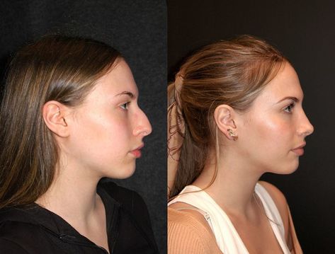 I was blown away when I saw this beautiful 20 year old woman 1 month after I performed her #closedrhinoplasty! She wanted a smaller more feminine nose, with a slight gentle curve to the bridge. I reduced her #nasalhump #dorsalhump, and created a more defined #nasaltip. She disliked how her nasal tip dropped when she smiled so I lifted it up! The #closedrhinoplasty approach heals much faster than an #openrhinoplasty, with less swelling, and no external incisions it scars!! She loves her new nose! Refined Nose Tip, Defined Nose Bridge, Defined Nose, Nose Rhinoplasty Before After, Nose Plastic Surgery Before After, Nose Before And After, Straight Nose Bridge, Feminine Nose, Before And After Nose Job