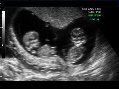 Miracles sonogram Twin Ultrasound, Twins Ultrasound, Baby Ultrasound Pictures, Having Twins, Ultrasound Technician, Raising Twins, Pregnancy Apps, Baby Ultrasound, Ultrasound Pictures