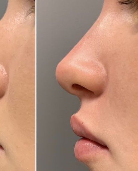 Perfect Nose Front View, Nose Job Inspo, Natural Nose Job, Nose Slimmer, Dream Nose, Nose Profile, Nose Aesthetic, Nose Types, Nose Jobs