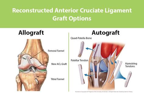 Physiotherapy Notes, Acl Surgery Recovery, Acl Rehab, Acl Reconstruction Surgery, Acl Recovery, Meniscal Tear, Acl Surgery, Anterior Cruciate Ligament, Knee Problem