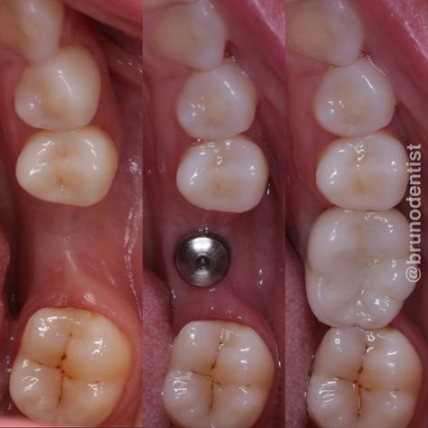 Clear Choice Dental Implants, Nexplanon Implant, Full Mouth Dental Implants, Tooth Implant, All On 4 Dental Implants, Dental Animation, Affordable Dental Implants, Dental Images, Dental Implant Surgery