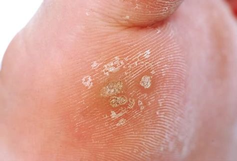 Plantar Wart Remedies, Viral Rash, Natural Wart Remover, Filiform Wart, Wart On Finger, Plantar Warts, Flat Warts, Types Of Warts, Facial Warts