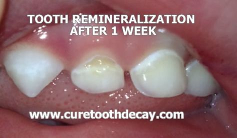 week 1_mini Cavity Remedy, Tooth Pain Relief, Cavities In Kids, Diy Toothpaste, Baby Tooth Decay, Tooth Decay Remedies, Tooth Repair, Homemade Toothpaste, Heal Cavities