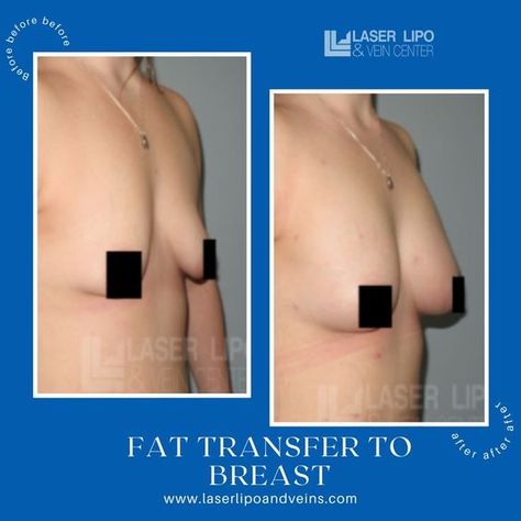 Fat Transfer To Breast, Breast Fat Transfer, Lipo Before And After, Laser Lipo, Fat Transfer, Phone Messages, After Pictures, Cosmetic Procedures, Before And After Pictures