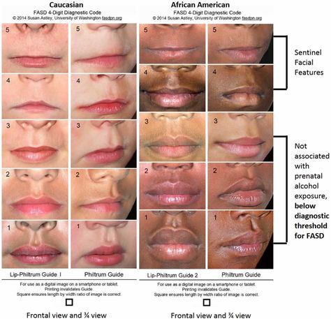 Philtrum of lip, causes of smooth philtrum, long or short philtrum Short Philtrum, Long Philtrum, Cerebellar Ataxia, Osteogenesis Imperfecta, Epidermolysis Bullosa, Fetal Alcohol Spectrum Disorder, Rare Genetic Disorders, Fetal Alcohol, Cleft Lip