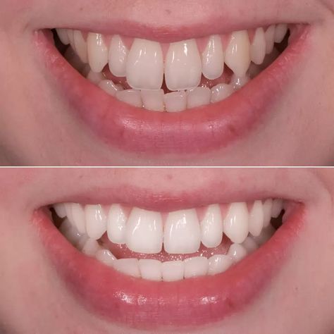 Crooked Teeth, Front Teeth, Tooth Enamel, Dental Cosmetics, Smile Makeover, Glamour Uk, Dental Procedures, Dental Insurance, First Tooth