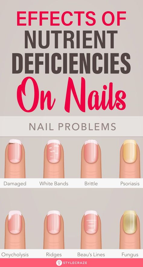 Effects Of Nutrient Deficiencies On Nails: Their shape, texture, color, growth rate – everything is a sign that your body is screaming for nutrients. Most of the changes in your nails and skin occur due to vitamin and nutrient deficiency. Here’s a list of symptoms that you may notice in your nails and what they mean for your health. #Nails #NailCare #NutritionDeficiency #NailCareTips Nail Health Signs, Nail Conditions, Nail Problems, Vitamin Deficiency, Magnesium Deficiency, Tongue Health, Health Signs, Nutrient Deficiency, Nail Care Tips