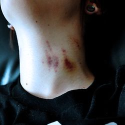 love bite Bite Aesthetics, Bite Marks Of Love, Love Bites Mark Aesthetic, Love Bite Snap, Love Bites Hickey, Hickies Neck Aesthetic Guy, Bite Mark Aesthetic, Neck Full Of Hickeys, Bite Mark