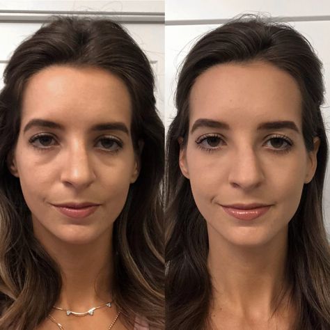 Remove Under Eye Bags, Botox Under Eyes, Jaw Reduction Surgery, Cosmetic Fillers, Plastic Surgery Fail, Under Eye Fillers, Botox Before And After, Plastic Surgery Gone Wrong, Face Surgery