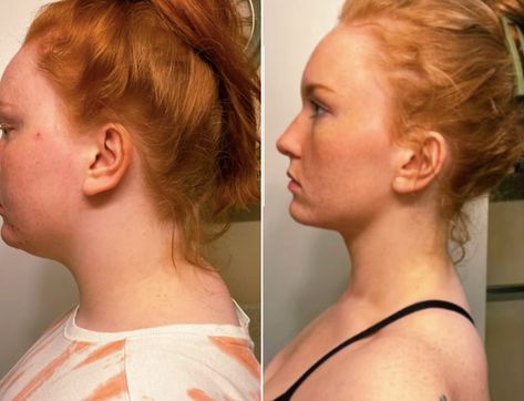 Woman shares exercises she claims fixed her "tech neck" in eight months Dowager Hump, Neck Strengthening, Dowager's Hump, Neck And Shoulder Exercises, Neck Hump, Tech Neck, Forward Head Posture, Muscular Strength, Neck Exercises