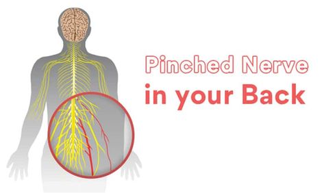 Discover the duration and relief options for pinched nerves – How long does a pinched nerve last and what you can do about it. - #Durationofatrappednerve #Durationofpinchednerverecovery #Howlongdoesacompressednervelast #Pinchednervehealingtime #Pinchednerverecoveryperiod #Pinchednervesymptomduration Nerves In Back, Nerve Conduction Study, Back Relief, Bulging Disc, Nerve Health, Pinched Nerve, Muscle Weakness, Magnetic Resonance, Nerve Damage