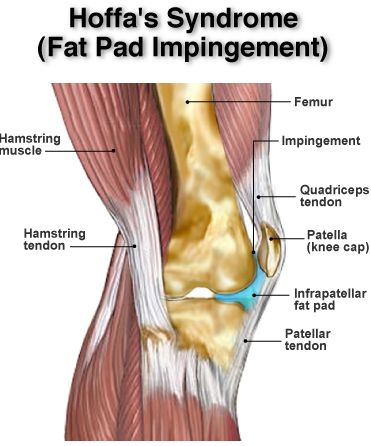 Infra-patellar Fat Pad Syndrome (Hoffa's Syndrome) | Physica Knee Fat, Patellar Tendon, Knee Pain Remedy, Swollen Knee, Knee Pain Exercises, Nerve Health, Knee Cap, Knee Exercises, Knee Pain Relief