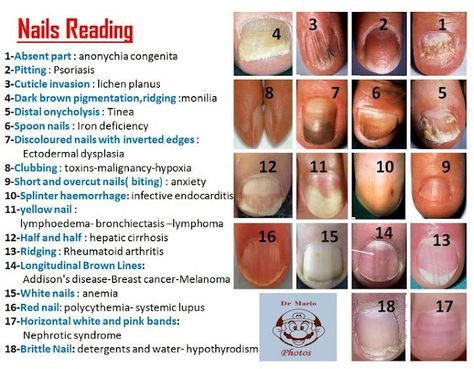 Nails reading chart Fingernail Health, Nail Disorders, Do It Yourself Nails, Nail Ridges, Lichen Planus, Vitamin Deficiency, Medical Facts, Health Talk, Toenail Fungus