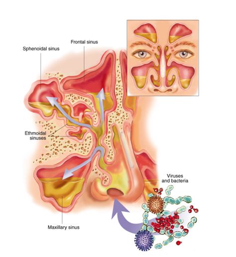 Sinus Infection Sinus Pressure Relief, Sick Remedies, Fashion Tips For Men, Stomach Problems, Sinus Infection, Working Mom Tips, Clear Skin Tips, Pelvic Pain, Natural Cold Remedies