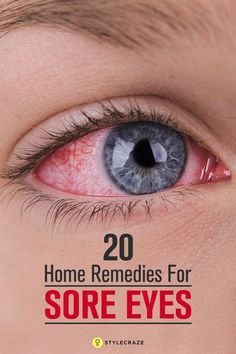 20 Effective Home Remedies For Sore Eyes Dry Eye Remedies, Natural Headache, Eye Pain, Irritated Eye, Eye Infections, Sore Eyes, Eyes Problems, Holistic Remedies, Headache Relief