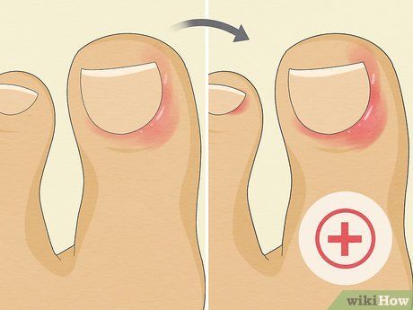 Infected Hangnail Remedy, Infected Cuticle, Infected Toenail, Toenail Fungal Infection, Kidney Pain, Nail Problems, Nail Infection, Animal Print Nails, Fungal Infection