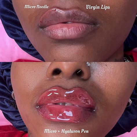 NO FILTER JUST FILLER 😍 APPOINTMENTS & TRAININGS available for lip filler services 😍 100% Hyaluronic Acid No Pain | No Downtime Natural Alternative Lasts 12 + Months With Proper Care 20-30 Min Procedure Lips Botox Natural, Hyaluronic Acid Lips, Lip Filler, Face Exercises, Lip Fillers, No Filter, Beauty Bar, Hyaluronic Acid, Body Works