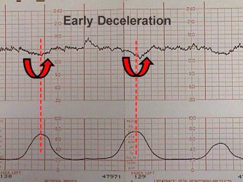 Decelerations Nursing, Fetal Monitoring Nursing, Fetal Heart Monitoring, Obstetrics Nursing, Cranial Nerves Mnemonic, Fetal Monitoring, Fetal Heart Rate, Labor Delivery Nursing, Ob Nursing