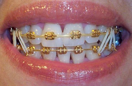 I wish I would have gotten these. Str8 thugin! Smile With Braces, Kawat Gigi, Bijoux Piercing Septum, Gold Braces, Natural Teeth Whitening Diy, Cute Braces Colors, Braces Tips, Getting Braces, Braces Girls