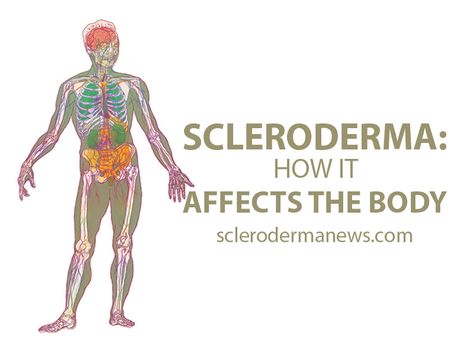 The symptoms of scleroderma vary greatly from person-to-person, and not all patients develop all complications. Learn some of them here. Scleroderma Symptoms, Autoimmune Disease Quotes, Scleroderma Awareness, Disease Quote, Agent Orange, Awareness Quotes, Swollen Legs, Autoimmune Disease, Stay Healthy