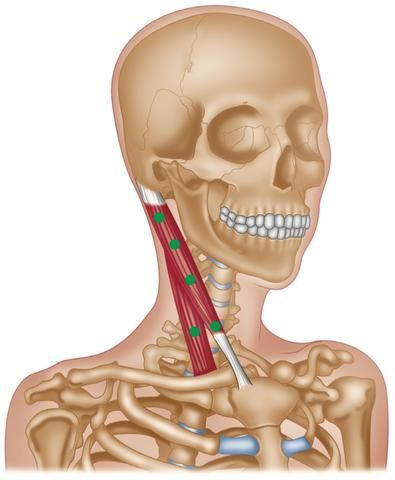 Sternocleidomastoideus (SCM) Trigger Points