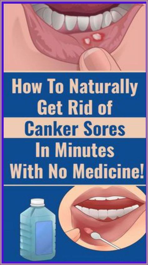 Canker Sores In The Mouth: Get Rid Of Them In Just One Day Without Using Any Medicine Fat Belly, Caring Meaning, Canker Sore, Stronger Teeth, Oral Health Care, Lose 40 Pounds, Tooth Decay, Warning Signs, Oral Health