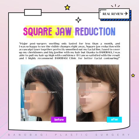 #banobagiplasticsurgery #plasticsurgeryinkorea #bestplasticsurgeoninkorea #plasticsurgerybeforeafter #koreancosmeticsurgery #facecontouringkorea #facecontour #fullfacecontouring #banobagi #koreanplasticsurgery #chinimplant #genioplasty #revisionsurgery #genioplastykorea #facecontouring #vlinesurgery #squarejawreduction #chinreduction #longface #genioplasty #zygoma #cheekbone #banobagi Zygoma Reduction, Chin Reduction, V Line Surgery, Square Jaw, Korean Plastic Surgery, Chin Implant, Facial Contouring, I Attract, Long Faces